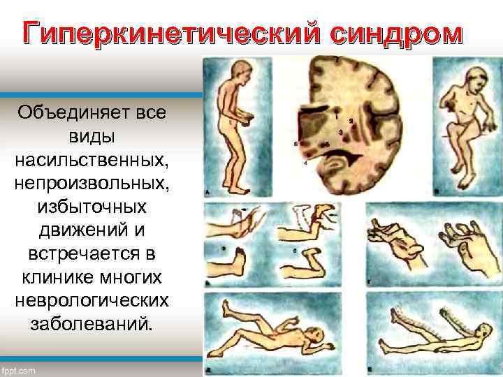 Гиперкинетический синдром (ГС) Объединяет все виды насильственных, непроизвольных, избыточных движений и встречается в клинике