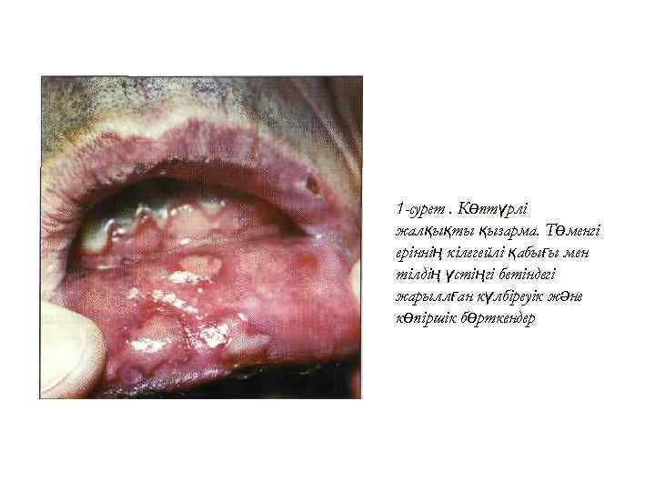 1 -сурет. Көптүрлі жалқықты қызарма. Төменгі ызарма еріннің кілегейлі қабығы мен тілдің үстіңгі бетіндегі