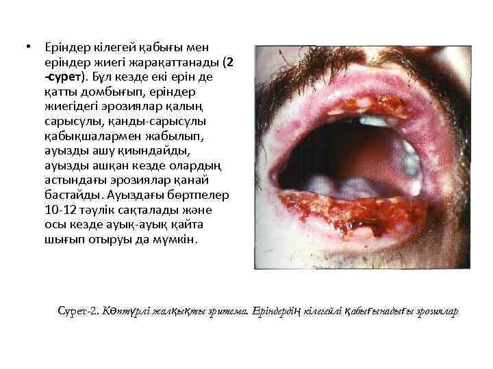  • Еріндер кілегей қабығы мен еріндер жиегі жарақаттанады (2 -сурет). Бұл кезде екі