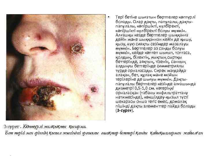  • Тері бетіне шығатын бөртпелер көптүрлі болады. Олар дақты, папулалы, дақтыпапулалы, көпіршікті, күлбіректі,