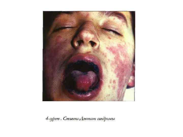 4 -сурет. Стивенс-Джонсон синдромы 