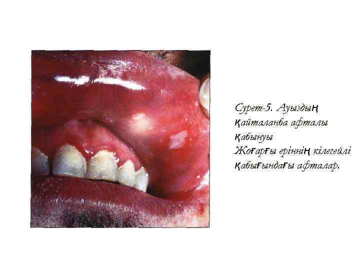 Сурет-5. Ауыздың қайталанба афталы қабынуы Жоғарғы еріннің кілегейлі қабығындағы афталар. 