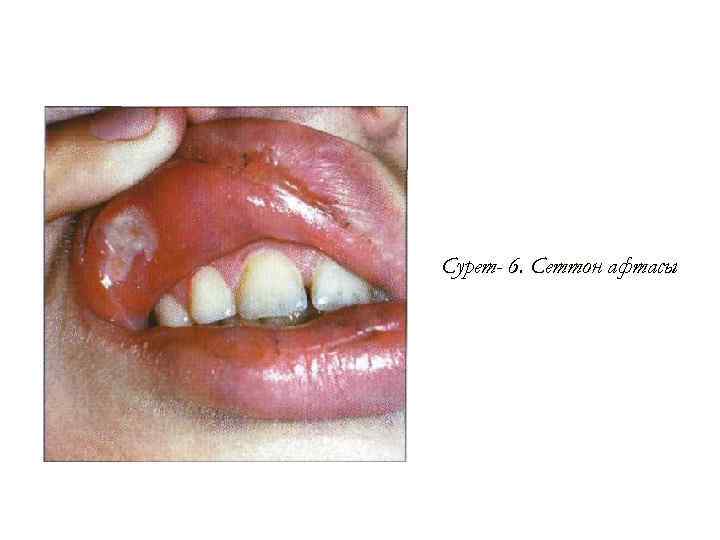 Сурет- 6. Сеттон афтасы 