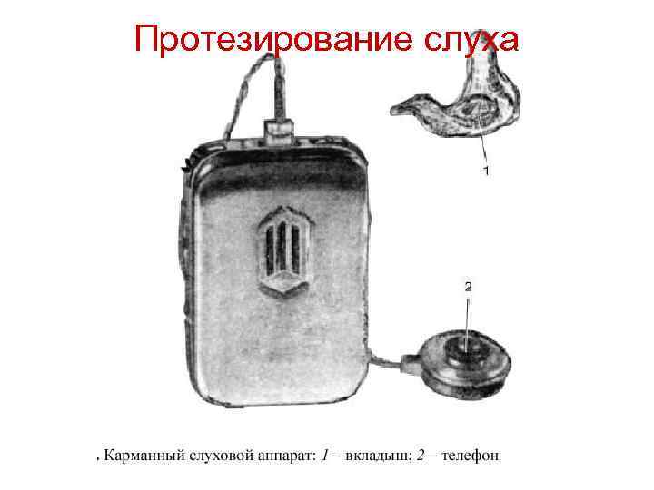 Протезирование слуха 