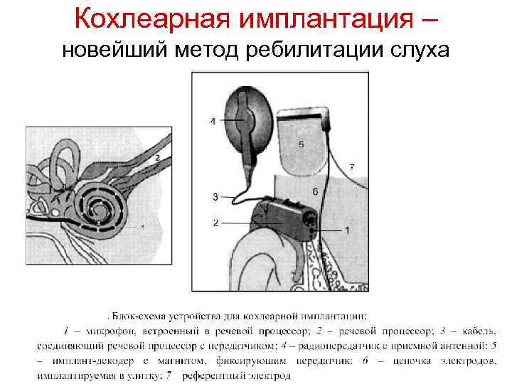 Кохлеарная имплантация – новейший метод ребилитации слуха 