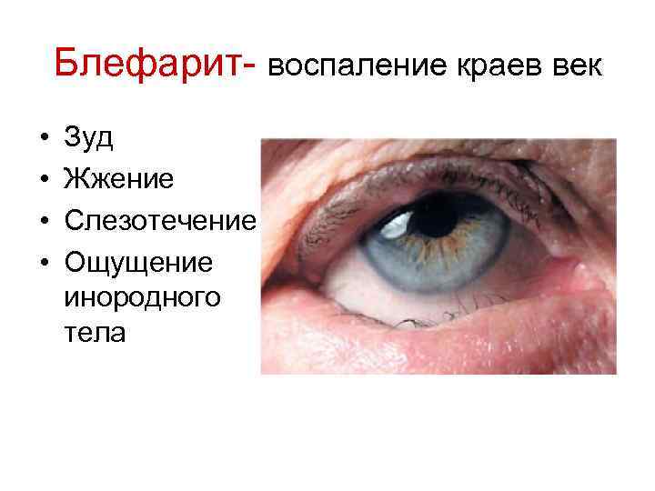 Блефарит- воспаление краев век • • Зуд Жжение Слезотечение Ощущение инородного тела 