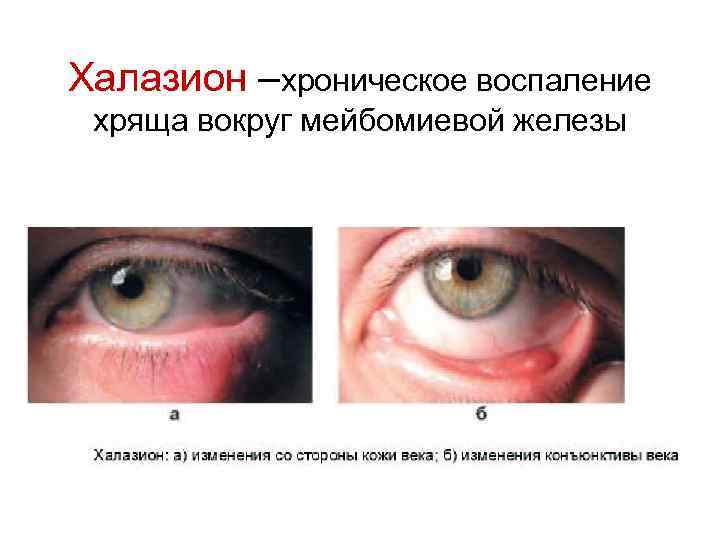 Халазион –хроническое воспаление хряща вокруг мейбомиевой железы 