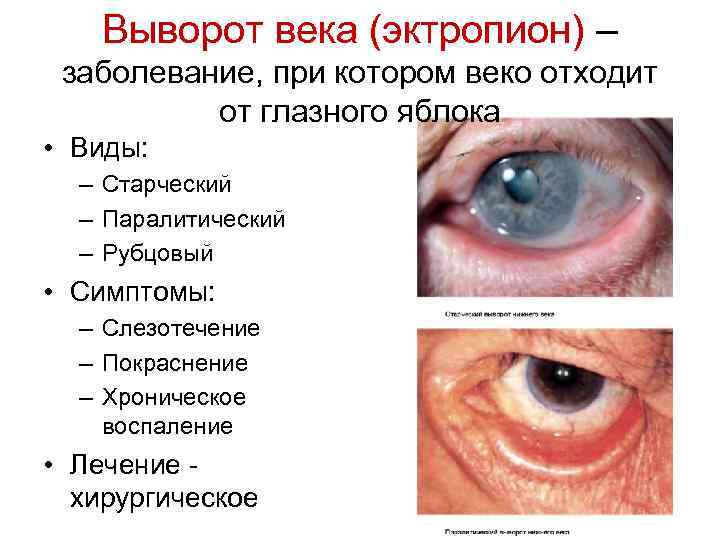 Выворот века (эктропион) – заболевание, при котором веко отходит от глазного яблока • Виды: