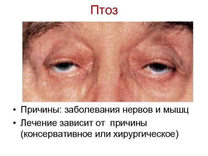 Птоз • Причины: заболевания нервов и мышц • Лечение зависит от причины (консервативное или