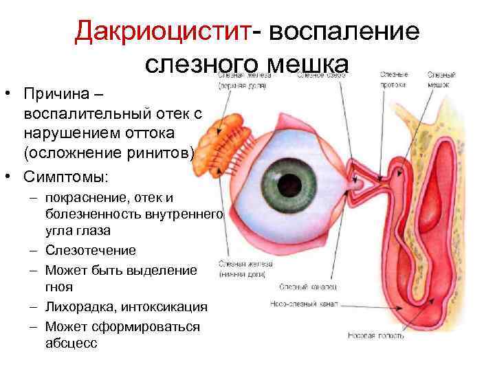 Дакриоцистит- воспаление слезного мешка • Причина – воспалительный отек с нарушением оттока (осложнение ринитов)