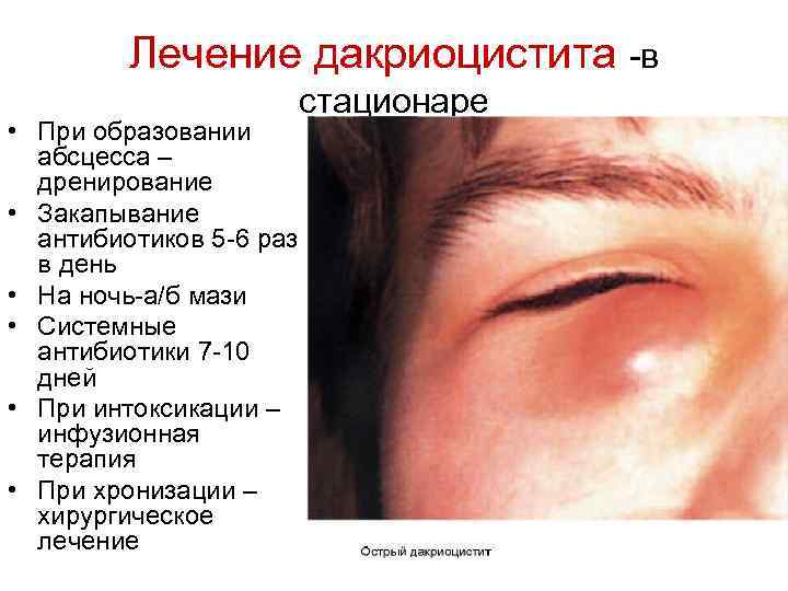 Лечение дакриоцистита -в • При образовании абсцесса – дренирование • Закапывание антибиотиков 5 -6