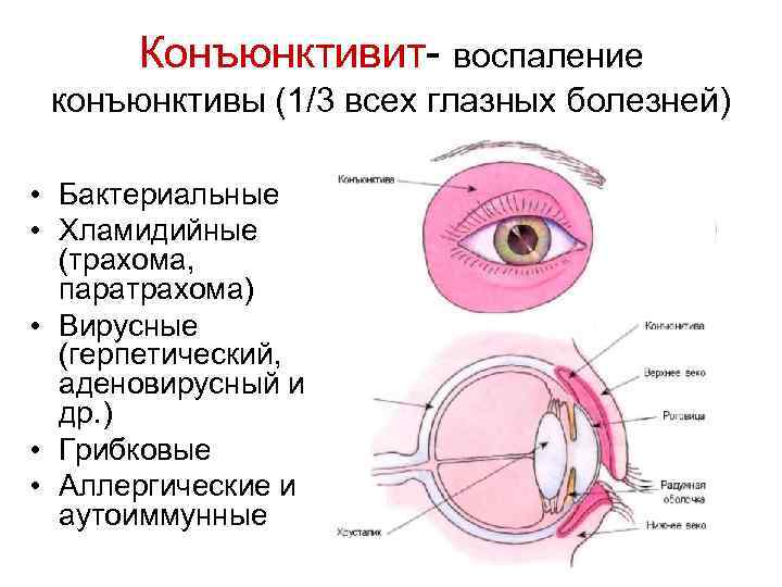 Конъюнктивит- воспаление конъюнктивы (1/3 всех глазных болезней) • Бактериальные • Хламидийные (трахома, паратрахома) •
