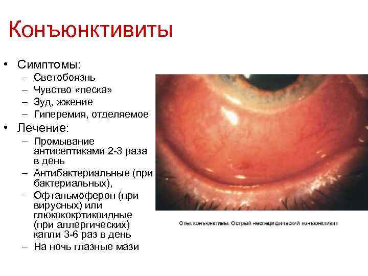 Конъюнктивиты • Симптомы: – – Светобоязнь Чувство «песка» Зуд, жжение Гиперемия, отделяемое • Лечение: