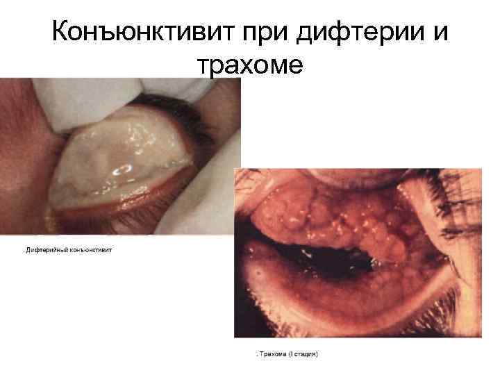 Конъюнктивит при дифтерии и трахоме 