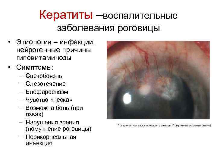 Кератиты –воспалительные заболевания роговицы • Этиология – инфекции, нейрогенные причины гиповитаминозы • Симптомы: –
