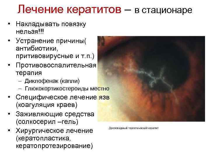Лечение кератитов – в стационаре • Накладывать повязку нельзя!!! • Устранение причины( антибиотики, притивовирусные
