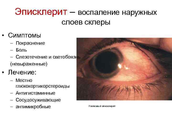 Эписклерит – воспаление наружных слоев склеры • Симптомы – Покраснение – Боль – Слезотечение