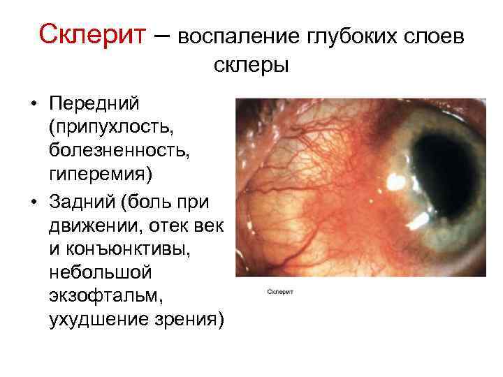 Склерит – воспаление глубоких слоев склеры • Передний (припухлость, болезненность, гиперемия) • Задний (боль