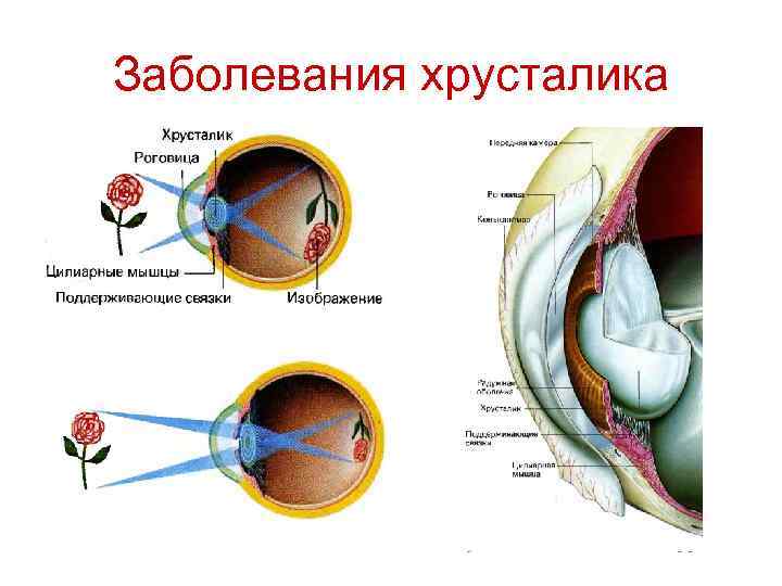 Заболевания хрусталика 