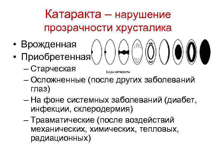 Катаракта – нарушение прозрачности хрусталика • Врожденная • Приобретенная – Старческая – Осложненные (после