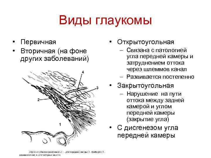 Виды глаукомы • Первичная • Вторичная (на фоне других заболеваний) • Открытоугольная – Связана