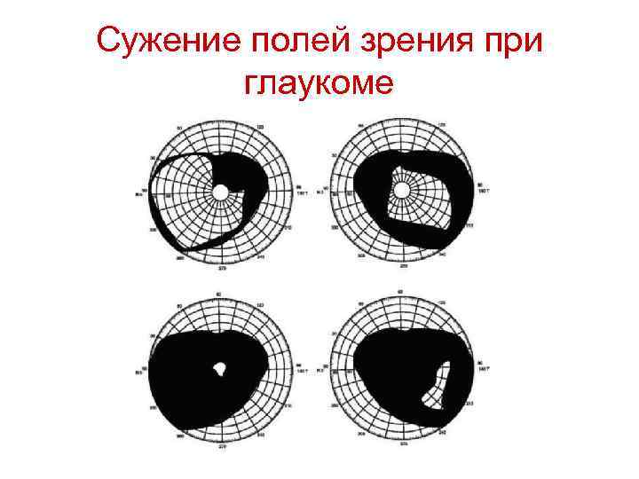 Сужение полей зрения при глаукоме 