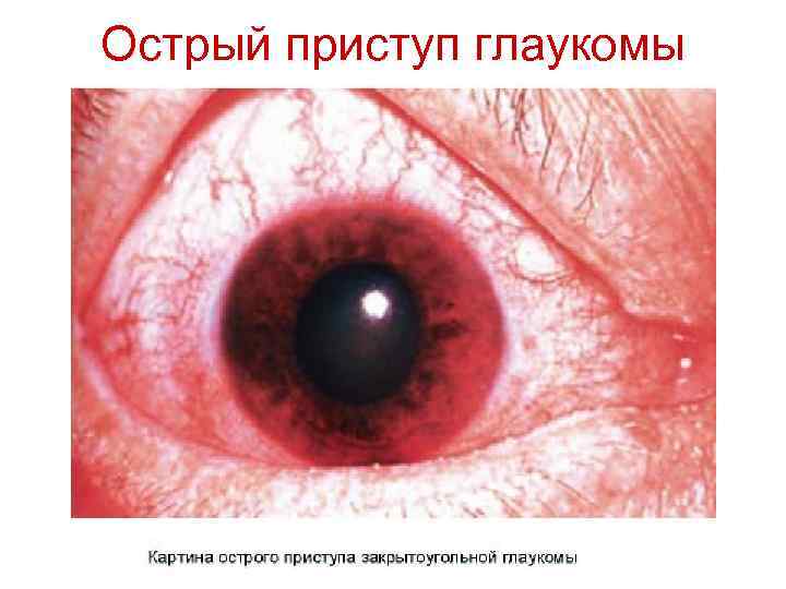 Острый приступ глаукомы 