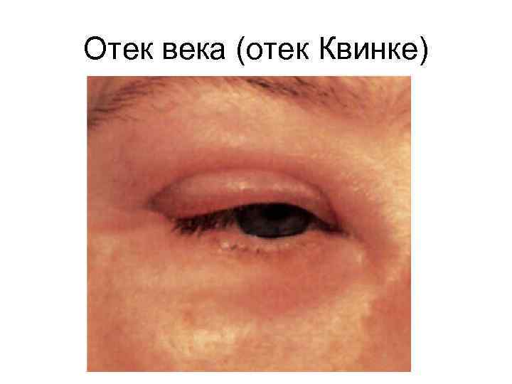 Отек века (отек Квинке) 