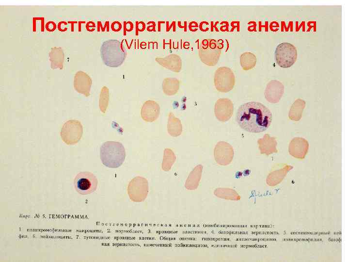 Постгеморрагическая анемия картинки