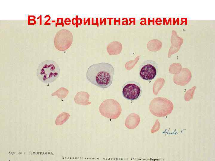 Анемия в12 дефицитная анемия картина крови