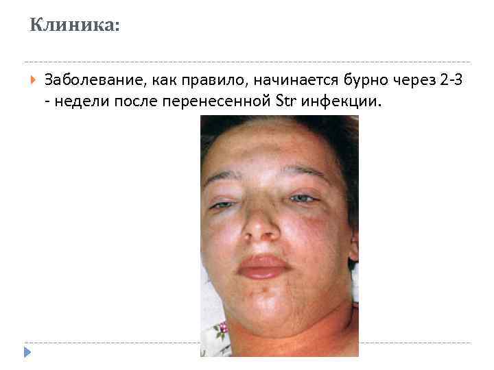 Клиника: Заболевание, как правило, начинается бурно через 2 -3 - недели после перенесенной Str