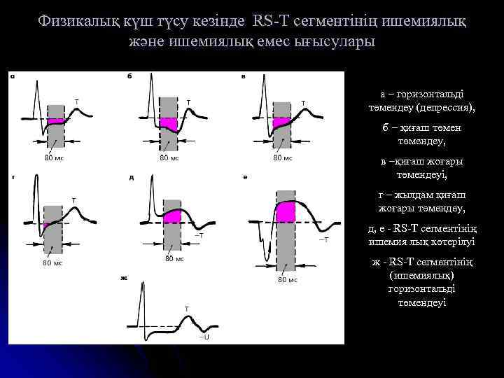 Физикалық күш түсу кезінде RS-T сегментінің ишемиялық және ишемиялық емес ығысулары а – горизонтальді