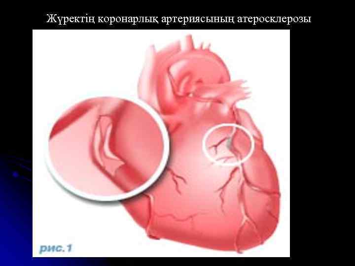 Жүректің коронарлық артериясының атеросклерозы 