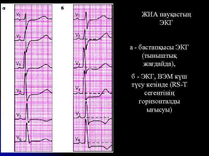 ЖИА науқастың ЭКГ а - бастапқысы ЭКГ (тыныштық жағдайда), б - ЭКГ, ВЭМ күш