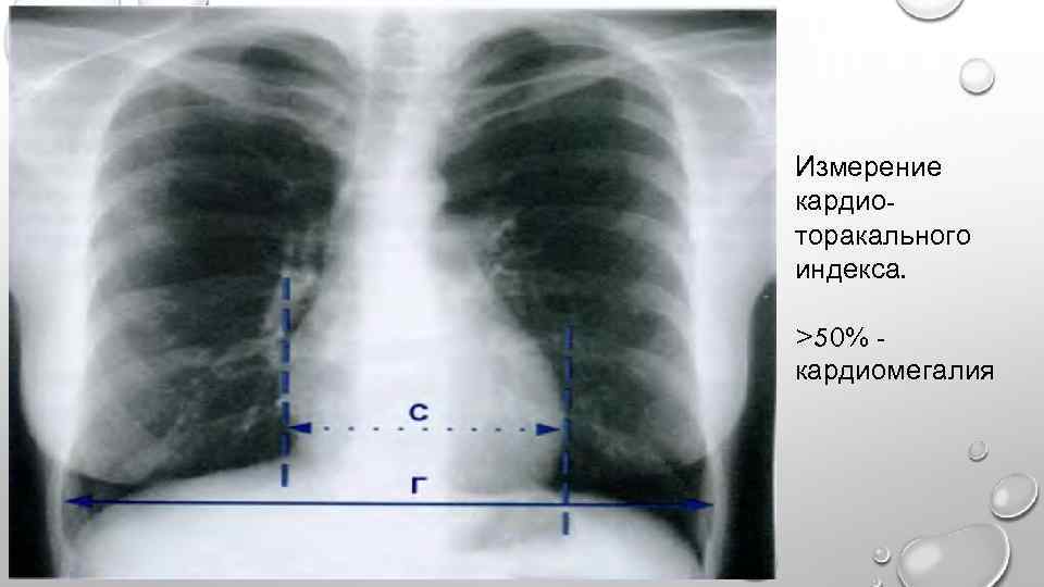 Измерение кардиоторакального индекса. >50% кардиомегалия 