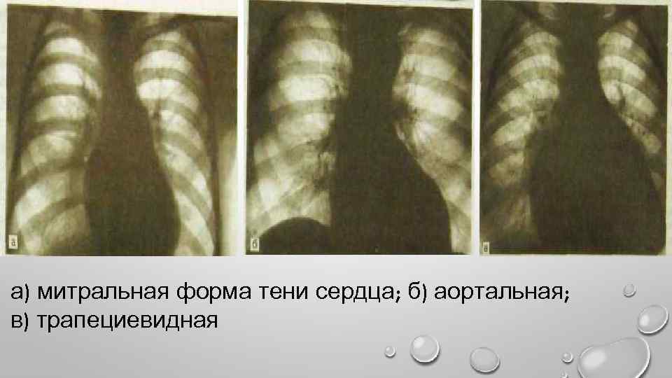 а) митральная форма тени сердца; б) аортальная; в) трапециевидная 