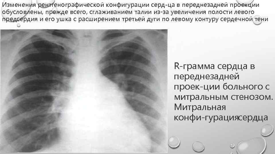 Изменения рентгенографической конфигурации серд ца в переднезадней проекции обусловлены, прежде всего, сглаживанием талии из-за