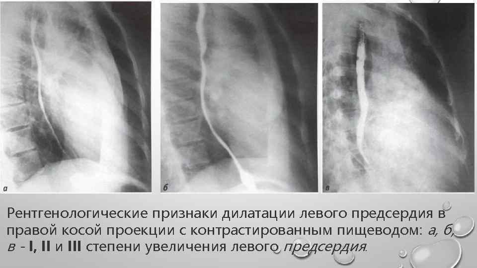 Дилатация левого. Дилатация левого предсердия. Начальная дилатация ЛП. Дилатация левого предсердия степени. Дементация левого предсердия.