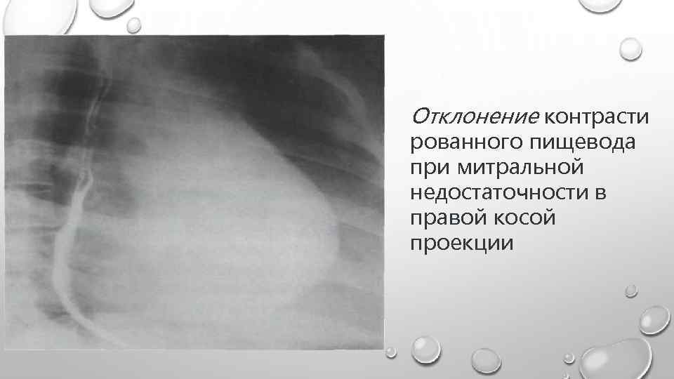 Отклонение контрасти рованного пищевода при митральной недостаточности в правой косой проекции 