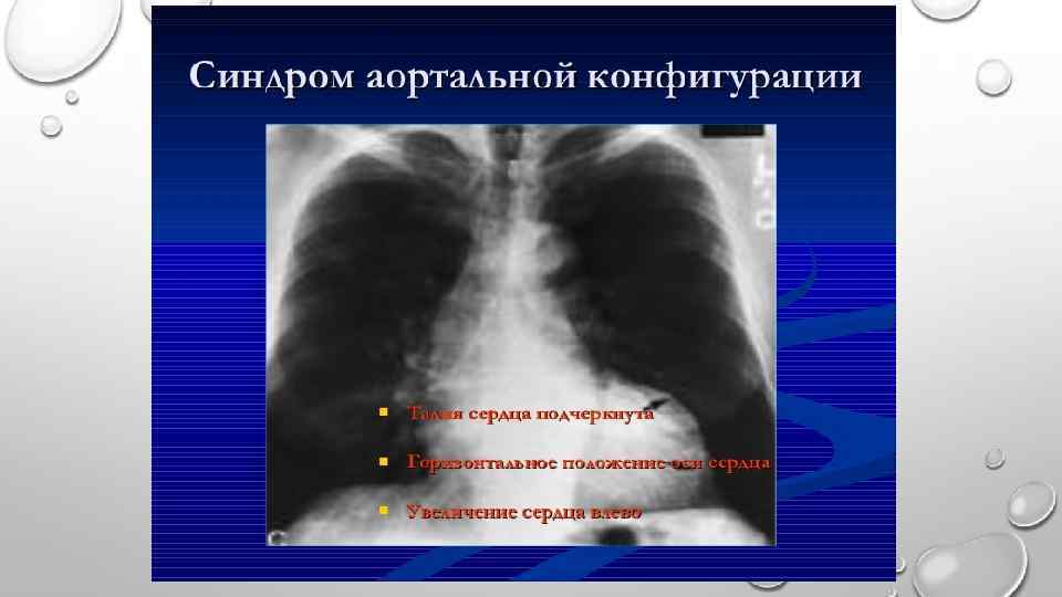 Конфигурация сердца. Аортальная конфигурация сердца. Синдром аортальной конфигурации сердца. Аортальная конфигурация сердца рентген. Аортальная конфигурация сердца причины.