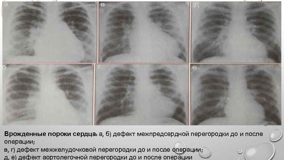 Врожденные пороки сердца: а, б) дефект межпредсердной перегородки до и после операции; в, г)