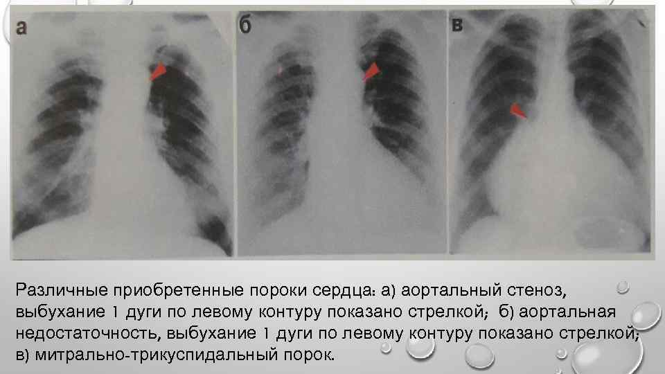 Различные приобретенные пороки сердца: а) аортальный стеноз, выбухание 1 дуги по левому контуру показано