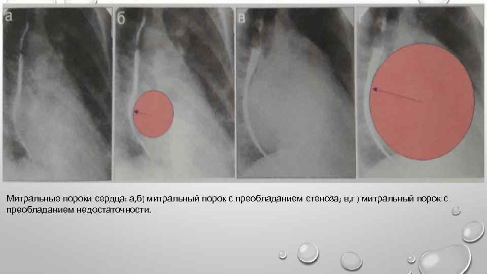 Митральные пороки сердца: а, б) митральный порок с преобладанием стеноза; в, г ) митральный