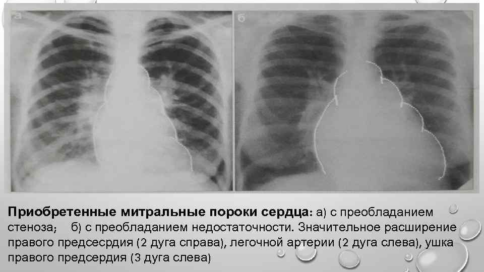 Приобретенные митральные пороки сердца: а) с преобладанием стеноза; б) с преобладанием недостаточности. Значительное расширение