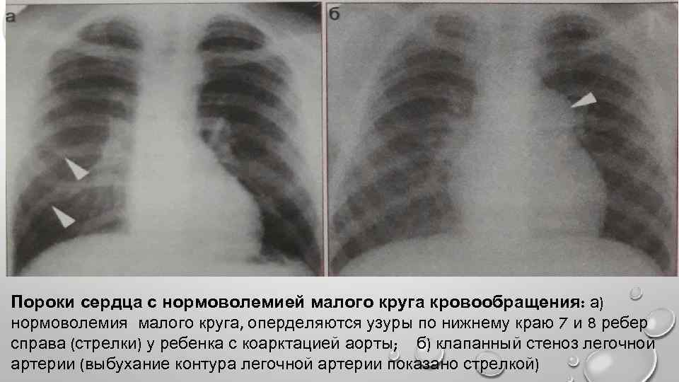 Пороки сердца с нормоволемией малого круга кровообращения: а) нормоволемия малого круга, оперделяются узуры по