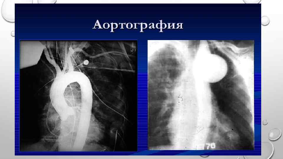 Аортит. Аортография аневризма аорты. Коарктация аорты аортография. Коарктация аорты рентгенограмма. Атеросклероз брюшной аорты рентген.