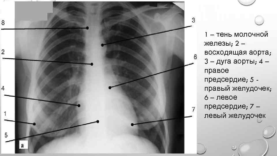 Тень сердца расширена. Рентген грудной клетки тень сердца. Дуга аорты на рентгенограмме. Тень сердца на рентгене. Тень аорты на рентгенограмме.