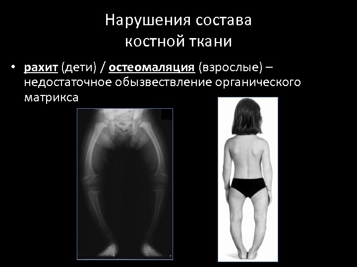 Нарушения состава костной ткани • рахит (дети) / остеомаляция (взрослые) – недостаточное обызвествление органического