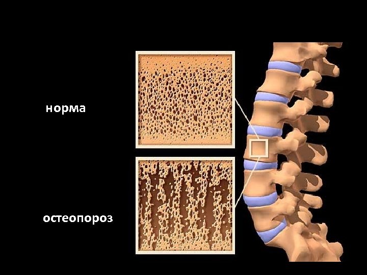 норма остеопороз 
