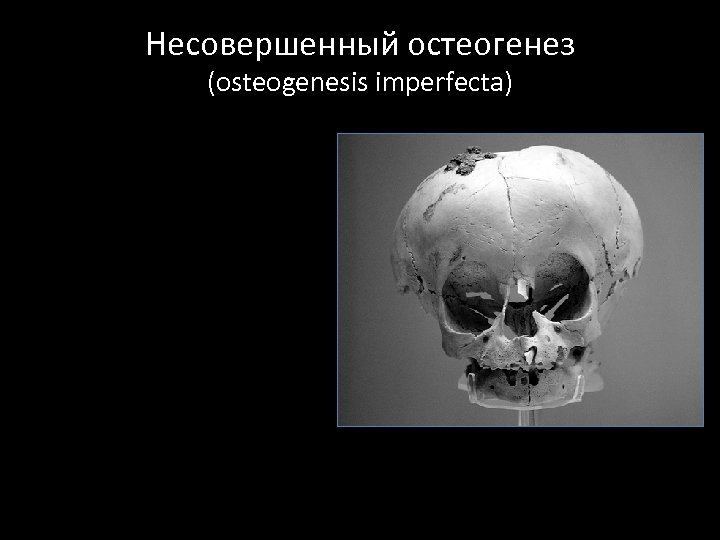Несовершенный остеогенез (osteogenesis imperfecta) 